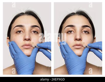 le visage d'une femme avant et après le traitement de botilage, avec la procédure effectuée sur son côté droit Banque D'Images