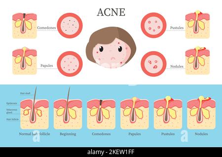 Types d'acné et étapes de progression infographiques, illustration de conception de style plat de vecteur. Acné vulgaris comedones formation de follicule de cheveux normal à Illustration de Vecteur