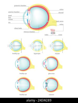 Schéma médical de la section transversale de l'anatomie de l'œil humain, illustration vectorielle isolée à plat. Structure de l'œil sain et avec glaucome, cataracte, hypermétropie, m Illustration de Vecteur