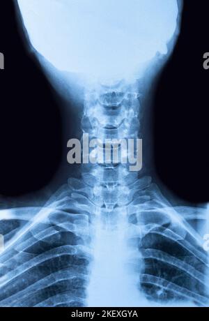 Image radiographique de la colonne cervicale du col supérieur d'un homme Banque D'Images