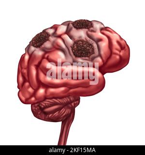 Cerveau nécrose liquefactive due à la perte de la circulation sanguine dans l'esprit après un accident vasculaire cérébral causé par le blocage des artères entraînant des dommages aux tissus morts Banque D'Images