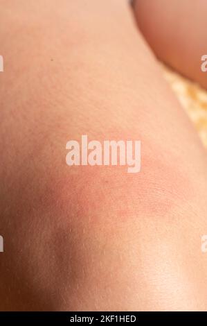 Allergie sur le corps humain et rougeur de la piqûre de guêpe, rougeur et piqûre de gros plan. Banque D'Images