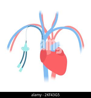 Schéma médical du cathéter veineux central tunnellisé Illustration de Vecteur