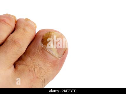 Gros plan sur les ongles du pied d'un homme sur un fond blanc Banque D'Images