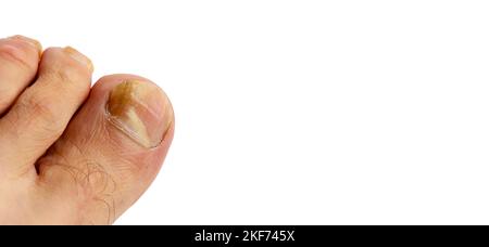 Gros plan sur les ongles du pied d'un homme sur un fond blanc Banque D'Images