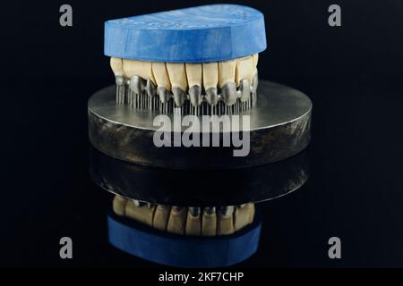 Couronnes dentaires à dents créées sur une imprimante 3D pour métal. Modèle en gypse sur un cadre métallique imprimé Banque D'Images