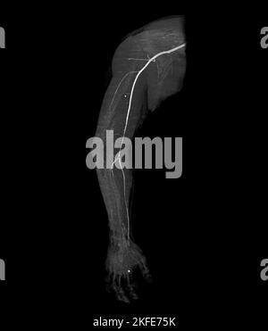 Image de rendu de l'artère brachiale CTA ou CT de l'extrémité supérieure 3D . Banque D'Images