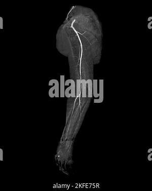 Image de rendu de l'artère brachiale CTA ou CT de l'extrémité supérieure 3D . Banque D'Images