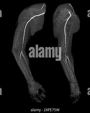 Image de rendu de l'artère brachiale CTA ou CT de l'extrémité supérieure 3D . Banque D'Images