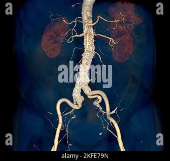 CTA aorte entière avec endoprothèse d'aorte abdominale, comparer l'image de rendu 3D en cas d'anévrismes aortiques abdominaux. Banque D'Images