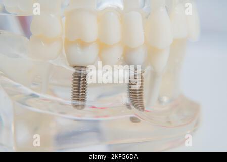 Un modèle de dents avec des implants se trouve sur une table in office Banque D'Images