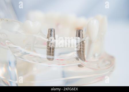 Un modèle de dents avec des implants se trouve sur une table in office Banque D'Images