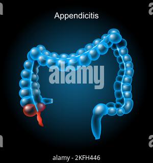 Appendicite. Inflammation de l'appendice. Gros intestin sur fond sombre. Tractus gastro-intestinal. Système digestif. Anatomie du corps humain. Vecteur Illustration de Vecteur