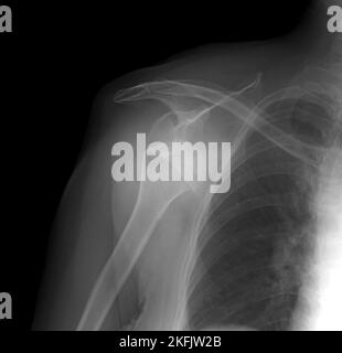 Luxation de l'épaule, X-ray Banque D'Images