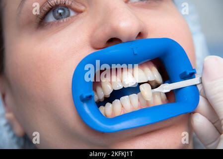 Procédure pour comparer les teintes de blanchiment des dents avant Banque D'Images