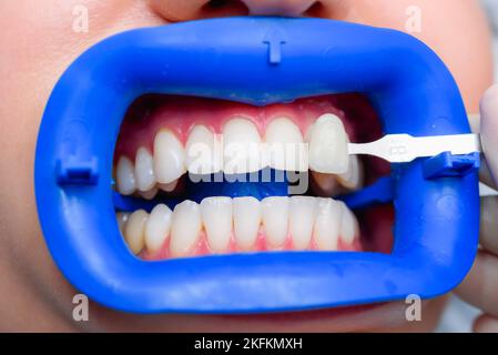 Procédure pour comparer la couleur de dents après le blanchiment Banque D'Images