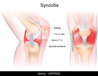 Synovitis d'un genou. Gros plan de l'articulation avec inflammation de la membrane synoviale. Signes et symptômes de la maladie. Anatomie articulaire synovial. Illustration de Vecteur