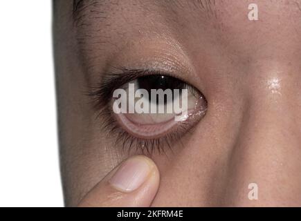 Peau pâle du jeune homme asiatique. Signe d'anémie. Pâleur à la paupière. Banque D'Images