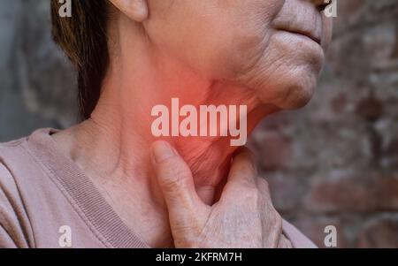 Rougeur au cou d'asiatique, femme de Myanmar. Notion : mal de gorge, pharyngite, laryngite, thyroïdite ou dysphagie. Banque D'Images