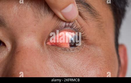 Infection cornéenne ou ulcère appelé kératite chez l'homme asiatique chinois. Yeux rouges. Inflammation de la sclérite appelée sclérite. Conjonctivite. Kératoconjonctivite. Banque D'Images