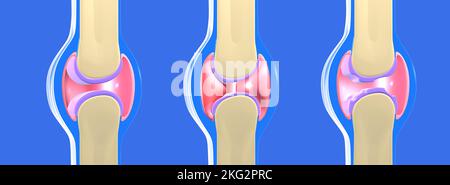 3D illustration de l'articulation synoviale et d'autres articulations avec l'arthrose et la polyarthrite rhumatoïde. Représentation graphique des os, des tendons. Banque D'Images