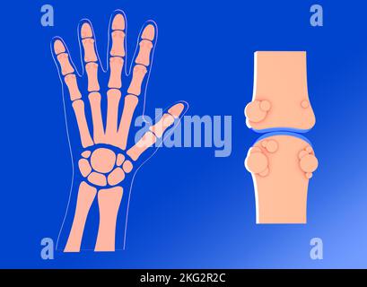 3D illustration de l'articulation synoviale avec l'arthrose. Avec la représentation graphique de la main et de ses os. Banque D'Images