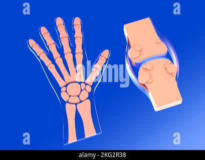 3D illustration de l'articulation synoviale avec l'arthrose. Avec la représentation graphique de la main et de ses os. Banque D'Images