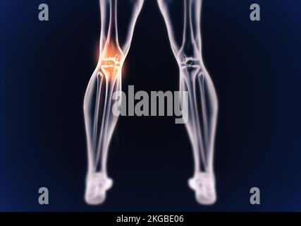 Quand l'inflammation frappe.Vue cgi d'un joint enflammé isolé en bleu. Banque D'Images