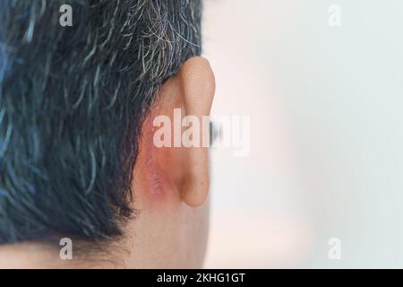 Homme ayant des problèmes d'oreille dus à la dermatite séborrhéique, au psoriasis, à la teigne tonsurante et à l'infection fongique de la peau Banque D'Images