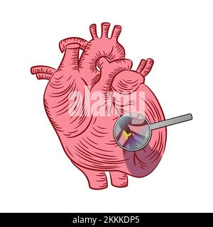 INFARCTUS DU MYOCARDE maladie cardiaque Schéma d'éducation Schéma vectoriel humain dessin manuel Illustration jeu pour impression Illustration de Vecteur