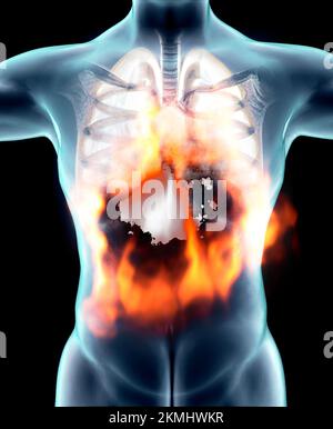 Anatomie humaine, problèmes avec le système respiratoire, poumons gravement endommagés. Pneumonie bilatérale. Covid-19, coronavirus. Patient et fumée. Fumeur Banque D'Images