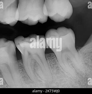 Dents molaires, côtés supérieur et inférieur droit, numéros 13,14,18,19 et 20. Une dent avec une radiographie orale de remplissage Banque D'Images