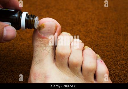 Champignon d'orteil et d'ongle. Dermatologue. Le médecin traite les pieds du patient Banque D'Images