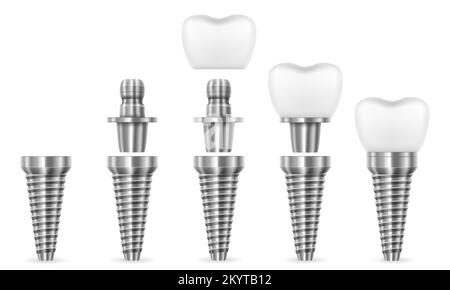 illustration du vecteur d'implant dentaire humain métallique isolée sur fond blanc Illustration de Vecteur