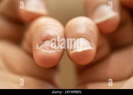 Onychophagy. Gros plan des doigts avec l'ongle mangé. Anxiété et nerfs. Banque D'Images