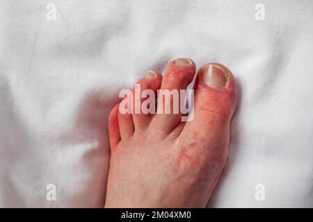 Chilblains sur les orteils, les bosses rouilleuses, le pied de la personne avec le phénomène de Raynaud et les lésions de chilblains Pernio dermatite sur les doigts Perniose Banque D'Images