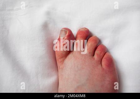 Chilblains sur les orteils, les bosses rouilleuses, le pied de la personne avec le phénomène de Raynaud et les lésions de chilblains Pernio dermatite sur les doigts Perniose Banque D'Images