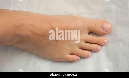 Vue de dessus des pieds et des orteils avec des ongles malsains. Banque D'Images