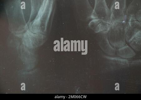 Radiographie d'une personne âgée atteinte d'ostéoporose et d'arthrite arthrose, destruction osseuse, diagnostic et traitement Banque D'Images