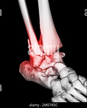 CT Scan cheville et pied ou tomodensitométrie de l'articulation cheville et pied 3Drendering image montrant la fracture du tibia et du péroné. Banque D'Images