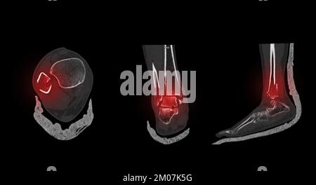 CT Scan cheville et pied ou tomodensitométrie de l'articulation cheville et pied 3Drendering image montrant la fracture du tibia et du péroné. Banque D'Images