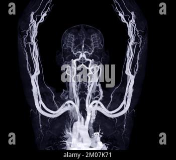 Artères brachiales du bras avec l'OS 3D des membres supérieurs rendu à partir du scanner CT. Banque D'Images