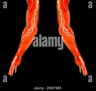 Artères brachiales du bras avec l'OS 3D des membres supérieurs rendu à partir du scanner CT. Banque D'Images