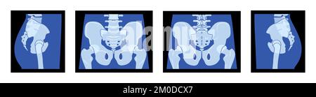 Ensemble de X-Ray bassin squelette hanche corps humain os adultes personnes roentgen avant vue latérale arrière. 3D concept bleu plat réaliste illustration vectorielle de l'anatomie médicale isolée sur fond noir Illustration de Vecteur