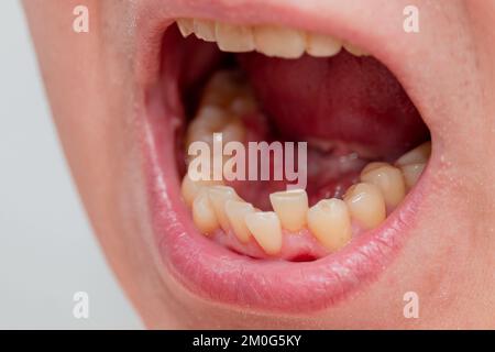 Européenne homme bouche ouverte, dents jaunes tordus lèvres sèches Banque D'Images