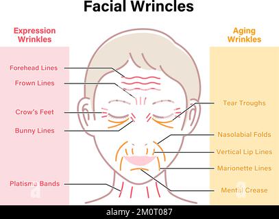 Rides d'expression et rides de vieillissement ( visage féminin ) illustration vectorielle Illustration de Vecteur