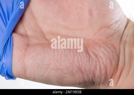 Le médecin retire ses gants en caoutchouc bleu, la peau sur ses mains est froissée de l'humidité. Se froisser les doigts après avoir porté des gants en caoutchouc pendant une longue période Banque D'Images