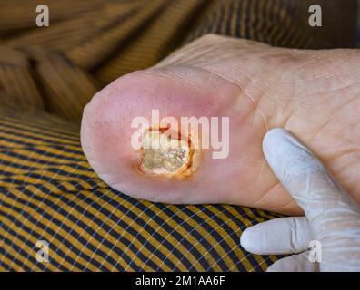 Diabète ulcère du pied dans le pied du patient asiatique mâle. Banque D'Images