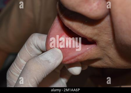 Ulcères aphteux ou ulcères de stress dans la bouche d'un patient asiatique de sexe masculin. Banque D'Images