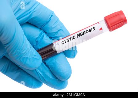 Fibrose kystique. Test sanguin de la maladie de la fibrose kystique dans la main du médecin Banque D'Images